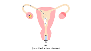 Intrauterine Insemination