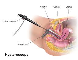 Hysteroscopy Surgery