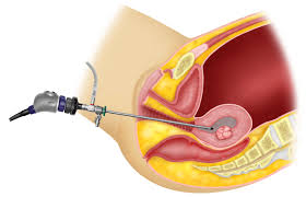 Hysteroscopy Cost in Mumbai