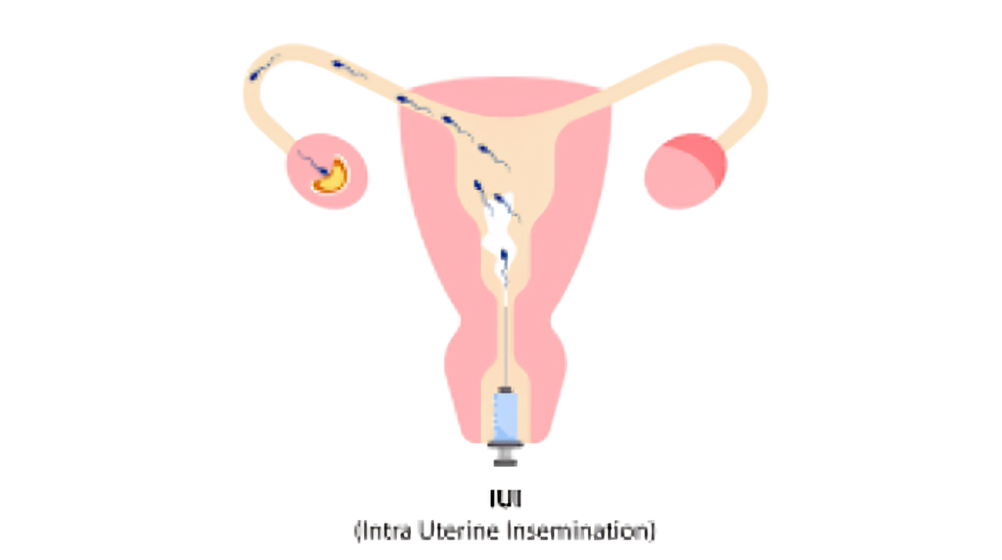 IUI Cost in Mumbai