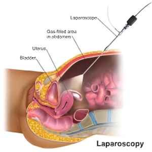 Laparoscopy Surgery