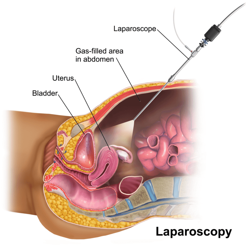 Laparoscopy Surgery: The Future of Fast Recovery and Tiny Scars
